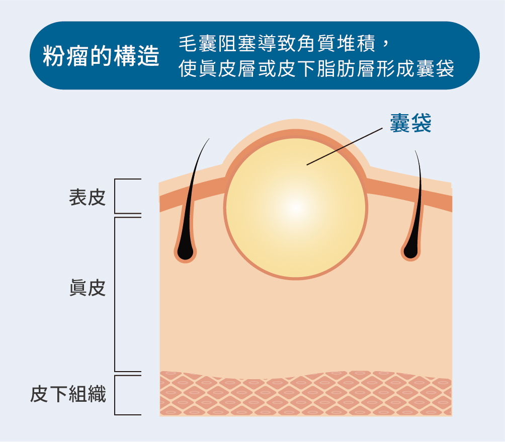 粉瘤的外觀特徵